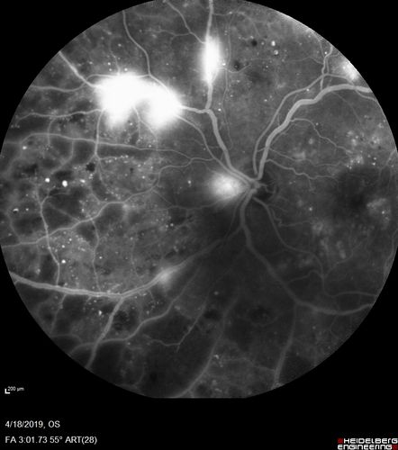 Moderate PDR
43 year old man 20/32 vision in both eyes.  Being started on Anti-VEGF injections which will be followed by PRP.
