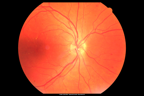 PDR NVD left eye and NVE right eye
41 year old diabetic woman with PDR in both eyes.  High risk in the left eye.  She had PRP, Avastin, and vitrectomy x 2 in the left eye with final vision of 20/25.  The right eye had eventually PRP laser
