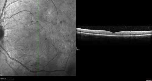 PDR NVD left eye and NVE right eye
41 year old diabetic woman with PDR in both eyes.  High risk in the left eye.  She had PRP, Avastin, and vitrectomy x 2 in the left eye with final vision of 20/25.  The right eye had eventually PRP laser
