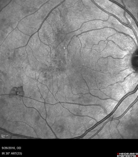 PDR NVD left eye and NVE right eye
41 year old diabetic woman with PDR in both eyes.  High risk in the left eye.  She had PRP, Avastin, and vitrectomy x 2 in the left eye with final vision of 20/25.  The right eye had eventually PRP laser
