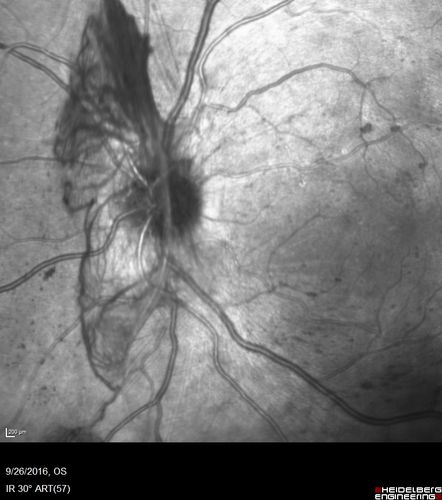 PDR NVD left eye and NVE right eye
41 year old diabetic woman with PDR in both eyes.  High risk in the left eye.  She had PRP, Avastin, and vitrectomy x 2 in the left eye with final vision of 20/25.  The right eye had eventually PRP laser
