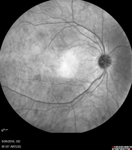 PDR NVD left eye and NVE right eye
41 year old diabetic woman with PDR in both eyes.  High risk in the left eye.  She had PRP, Avastin, and vitrectomy x 2 in the left eye with final vision of 20/25.  The right eye had eventually PRP laser
