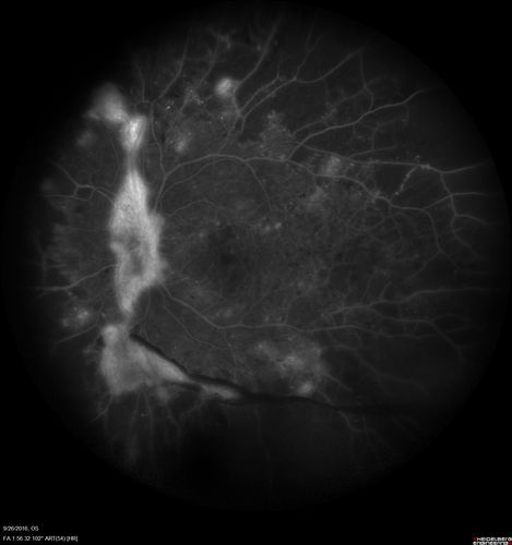 PDR NVD left eye and NVE right eye
41 year old diabetic woman with PDR in both eyes.  High risk in the left eye.  She had PRP, Avastin, and vitrectomy x 2 in the left eye with final vision of 20/25.  The right eye had eventually PRP laser
