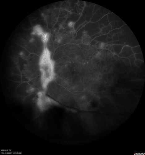 PDR NVD left eye and NVE right eye
41 year old diabetic woman with PDR in both eyes.  High risk in the left eye.  She had PRP, Avastin, and vitrectomy x 2 in the left eye with final vision of 20/25.  The right eye had eventually PRP laser
