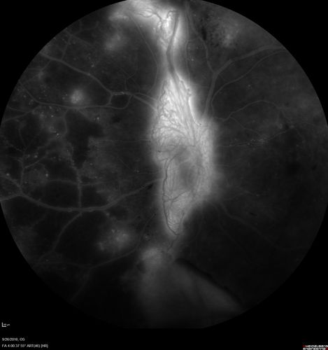 PDR NVD left eye and NVE right eye
41 year old diabetic woman with PDR in both eyes.  High risk in the left eye.  She had PRP, Avastin, and vitrectomy x 2 in the left eye with final vision of 20/25.  The right eye had eventually PRP laser

