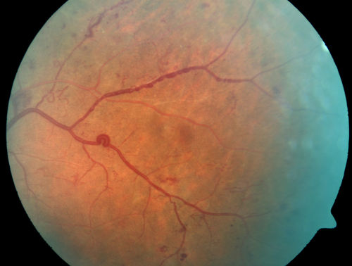 Proliferative Diabetic Retinopathy - Moderate - mild NVD with NVE 
Venous beading, vascular loops and NVE are visible on photos
