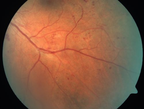Proliferative Diabetic Retinopathy - Moderate - mild NVD with NVE 
Venous beading, vascular loops and NVE are visible on photos
