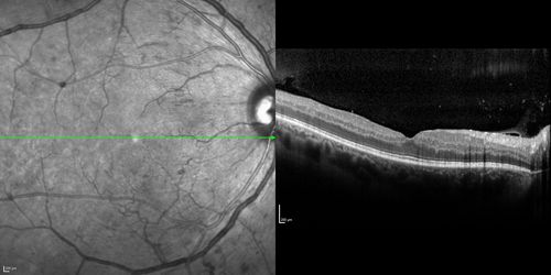 Proliferative Diabetic Retinopathy - Moderate - mild NVD with NVE 
SD OCT shows no significant macular edema
