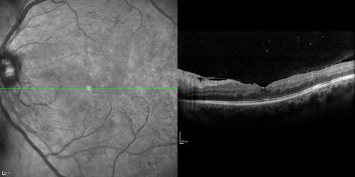 Proliferative Diabetic Retinopathy - Moderate - mild NVD with NVE 
SD OCT shows no significant macular edema
