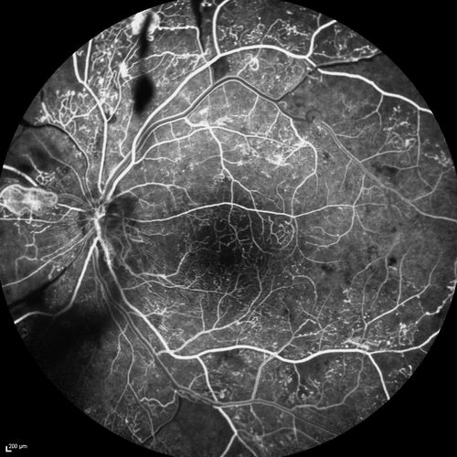 Proliferative Diabetic Retinopathy - Moderate - mild NVD with NVE 
FA shows leakage from neovascularization and dark areas in periphery from non-perfusion
