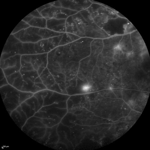 Proliferative Diabetic Retinopathy - Moderate - mild NVD with NVE 
FA shows leakage from neovascularization and dark areas in periphery from non-perfusion
