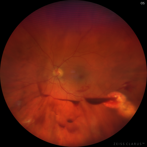 PDR and Vitreous Hemorrhage - High Risk Left Eye - Low Risk Right Eye
50 year old man with type I diabetes mellitus for 26 years.  New Vitreous Hemorrhage in the left eye.  Both eyes have NVE.  Both also have foveal hypoplasia
