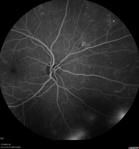 PDR and Vitreous Hemorrhage - High Risk Left Eye - Low Risk Right Eye
50 year old man with type I diabetes mellitus for 26 years.  New Vitreous Hemorrhage in the left eye.  Both eyes have NVE.  Both also have foveal hypoplasia
