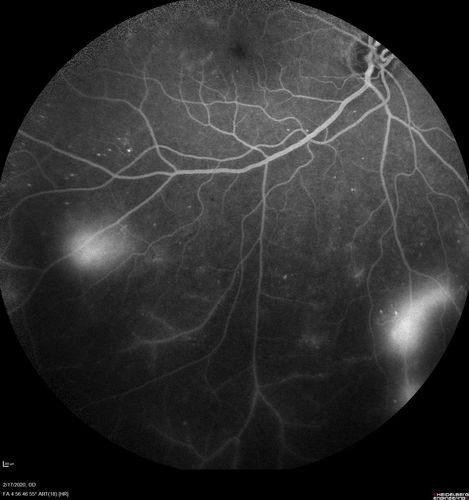PDR and Vitreous Hemorrhage - High Risk Left Eye - Low Risk Right Eye
50 year old man with type I diabetes mellitus for 26 years.  New Vitreous Hemorrhage in the left eye.  Both eyes have NVE.  Both also have foveal hypoplasia
