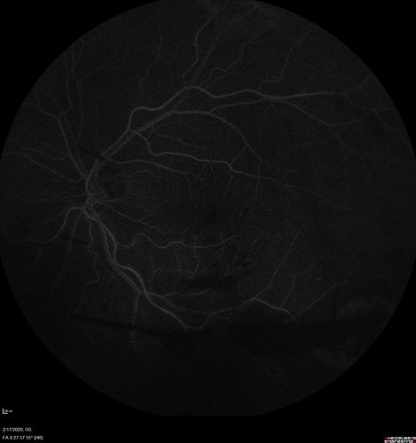 PDR and Vitreous Hemorrhage - High Risk Left Eye - Low Risk Right Eye
50 year old man with type I diabetes mellitus for 26 years.  New Vitreous Hemorrhage in the left eye.  Both eyes have NVE.  Both also have foveal hypoplasia
