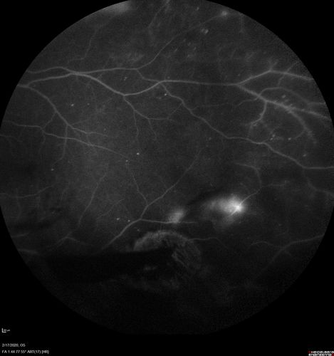 PDR and Vitreous Hemorrhage - High Risk Left Eye - Low Risk Right Eye
50 year old man with type I diabetes mellitus for 26 years.  New Vitreous Hemorrhage in the left eye.  Both eyes have NVE.  Both also have foveal hypoplasia
