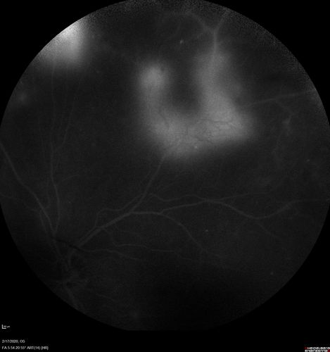 PDR and Vitreous Hemorrhage - High Risk Left Eye - Low Risk Right Eye
50 year old man with type I diabetes mellitus for 26 years.  New Vitreous Hemorrhage in the left eye.  Both eyes have NVE.  Both also have foveal hypoplasia
