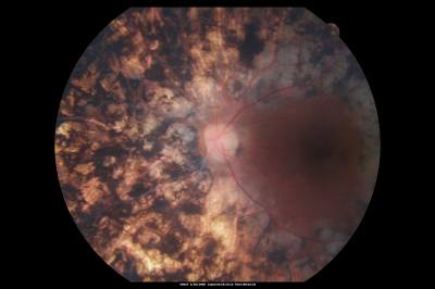PDR with heavy PRP laser and worsening macular edema 
51-year-old woman has had extensive laser in both eyes done years ago elsewhere. Her left eye has gradually been declining with macular edema.
VISUAL ACUITY: OD 20/40, OS 20/40
