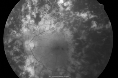 PDR with heavy PRP laser and worsening macular edema red free photo
51-year-old woman has had extensive laser in both eyes done years ago elsewhere. Her left eye has gradually been declining with macular edema.
VISUAL ACUITY: OD 20/40, OS 20/40

