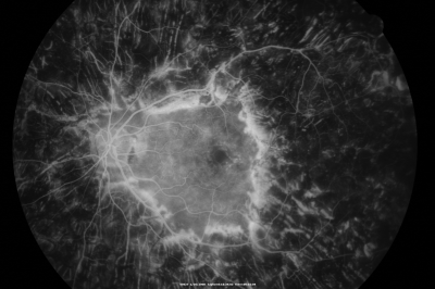 PDR with heavy PRP laser and worsening macular edema early FA
51-year-old woman has had extensive laser in both eyes done years ago elsewhere. Her left eye has gradually been declining with macular edema.
VISUAL ACUITY: OD 20/40, OS 20/40
