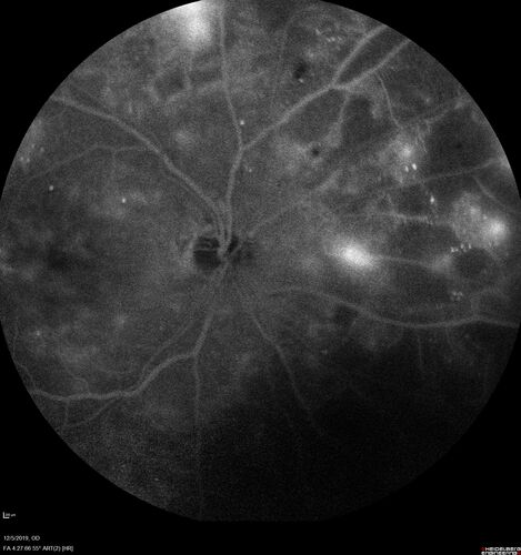 Proliferative diabetic retinopathy with vitreous hemorrhage
53 year old man with foggy vision in the left eye for one day.  VA 20/25 OD, 20/40 OS.  Diabetes for 10 years.  Type II

