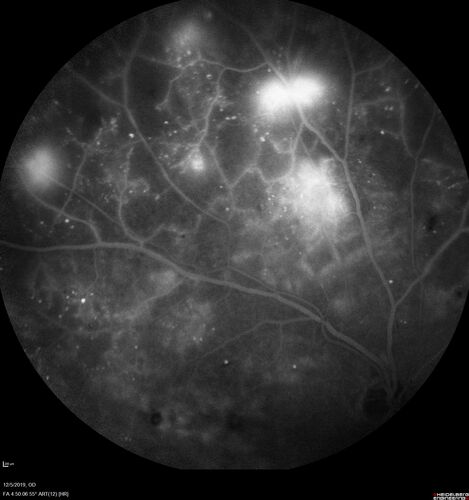 Proliferative diabetic retinopathy with vitreous hemorrhage
53 year old man with foggy vision in the left eye for one day.  VA 20/25 OD, 20/40 OS.  Diabetes for 10 years.  Type II
