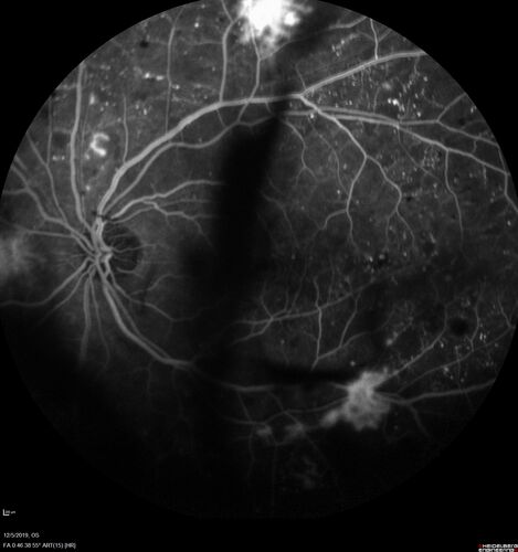 Proliferative diabetic retinopathy with vitreous hemorrhage
53 year old man with foggy vision in the left eye for one day.  VA 20/25 OD, 20/40 OS.  Diabetes for 10 years.  Type II
