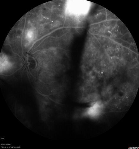 Proliferative diabetic retinopathy with vitreous hemorrhage
53 year old man with foggy vision in the left eye for one day.  VA 20/25 OD, 20/40 OS.  Diabetes for 10 years.  Type II
