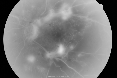 Proliferative Diabetic Retinopathy - Vitreous Hemorrhage and Tractional Retinal Detachment Left Eye
52-year-old man has been diabetic for nineteen years developed substantial vision loss over the last month or two. OD 20/70, OS 20/200.52-year-old man has been diabetic for nineteen years developed substantial vision loss over the last month or two. OD 20/70, OS 20/200.
Keywords: fibrosis