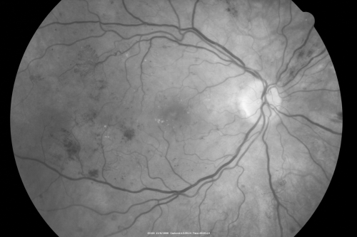 Proliferative Diabetic Retinopathy - Vitreous Hemorrhage and Tractional Retinal Detachment Left Eye
52-year-old man has been diabetic for nineteen years developed substantial vision loss over the last month or two. OD 20/70, OS 20/200.
