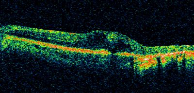 PDR with heavy PRP laser and worsening macular edema OCT line scan
51-year-old woman has had extensive laser in both eyes done years ago elsewhere. Her left eye has gradually been declining with macular edema.
VISUAL ACUITY: OD 20/40, OS 20/40
