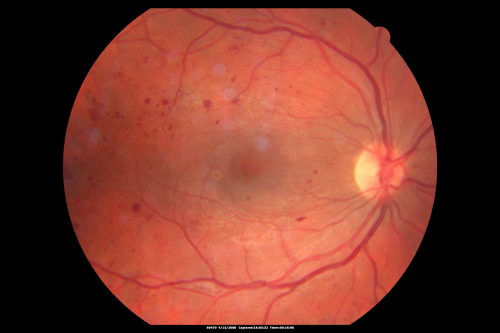 Proliferative Diabetic Retinopathy in patient with Moyamoya Disease
28-year-old womandiabetic since age nine, and she also has had multiple strokes.  OD is 20/30, OS is 20/30.

