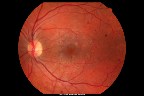 Proliferative Diabetic Retinopathy in patient with Moyamoya Disease
28-year-old womandiabetic since age nine, and she also has had multiple strokes.  OD is 20/30, OS is 20/30.
