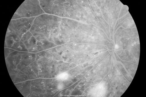Proliferative Diabetic Retinopathy in patient with Moyamoya Disease
28-year-old womandiabetic since age nine, and she also has had multiple strokes.  OD is 20/30, OS is 20/30.
