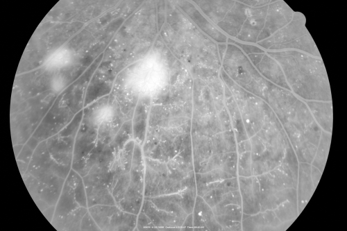 Proliferative Diabetic Retinopathy in patient with Moyamoya Disease
28-year-old womandiabetic since age nine, and she also has had multiple strokes.  OD is 20/30, OS is 20/30.

