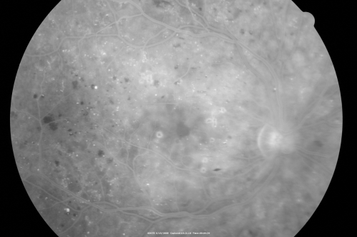 Proliferative Diabetic Retinopathy in patient with Moyamoya Disease
28-year-old womandiabetic since age nine, and she also has had multiple strokes.  OD is 20/30, OS is 20/30.
