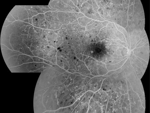 Proliferative Diabetic Retinopathy in patient with Moyamoya Disease
28-year-old womandiabetic since age nine, and she also has had multiple strokes.  OD is 20/30, OS is 20/30.
