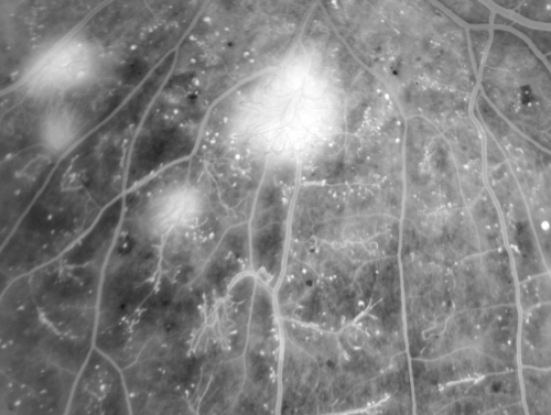 Proliferative Diabetic Retinopathy in patient with Moyamoya Disease
28-year-old womandiabetic since age nine, and she also has had multiple strokes.  OD is 20/30, OS is 20/30.
