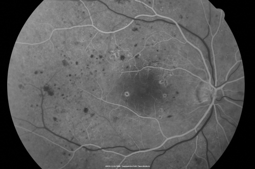 Proliferative Diabetic Retinopathy in patient with Moyamoya Disease
28-year-old womandiabetic since age nine, and she also has had multiple strokes.  OD is 20/30, OS is 20/30.
