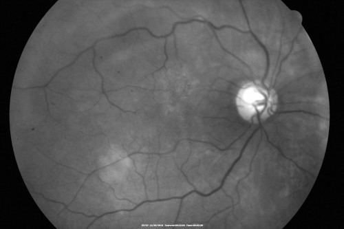 Proliferative Diabetic Retinopathy Both Eyes - Vitreous Hemorrahge Left Eye
67-year-old man has proliferative diabetic retinopathy in both eyes with vitreous hemorrhage in the left eye.  He has had pan retinal laser in the left eye.  The vitreous hemorrhage has been there for greater than two years and his vision is still hazy.  He takes Lumigan in both eyes for his glaucoma.  

VISUAL ACUITY:  OD 20/40,  OS 20/40
