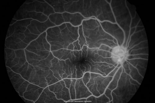 Proliferative Diabetic Retinopathy Both Eyes - Vitreous Hemorrahge Left Eye
67-year-old man has proliferative diabetic retinopathy in both eyes with vitreous hemorrhage in the left eye.  He has had pan retinal laser in the left eye.  The vitreous hemorrhage has been there for greater than two years and his vision is still hazy.  He takes Lumigan in both eyes for his glaucoma.  

VISUAL ACUITY:  OD 20/40,  OS 20/40

