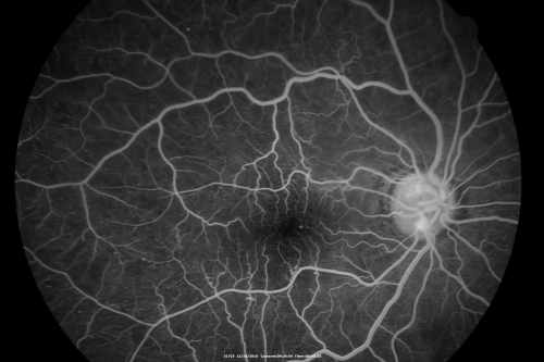 Proliferative Diabetic Retinopathy Both Eyes - Vitreous Hemorrahge Left Eye
67-year-old man has proliferative diabetic retinopathy in both eyes with vitreous hemorrhage in the left eye.  He has had pan retinal laser in the left eye.  The vitreous hemorrhage has been there for greater than two years and his vision is still hazy.  He takes Lumigan in both eyes for his glaucoma.  

VISUAL ACUITY:  OD 20/40,  OS 20/40
