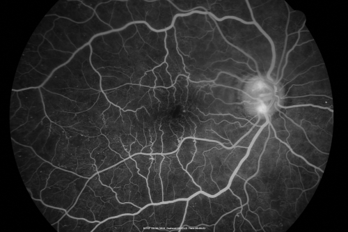 Proliferative Diabetic Retinopathy Both Eyes - Vitreous Hemorrahge Left Eye
67-year-old man has proliferative diabetic retinopathy in both eyes with vitreous hemorrhage in the left eye.  He has had pan retinal laser in the left eye.  The vitreous hemorrhage has been there for greater than two years and his vision is still hazy.  He takes Lumigan in both eyes for his glaucoma.  

VISUAL ACUITY:  OD 20/40,  OS 20/40
