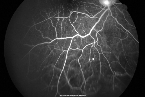 Proliferative Diabetic Retinopathy Both Eyes - Vitreous Hemorrahge Left Eye
67-year-old man has proliferative diabetic retinopathy in both eyes with vitreous hemorrhage in the left eye.  He has had pan retinal laser in the left eye.  The vitreous hemorrhage has been there for greater than two years and his vision is still hazy.  He takes Lumigan in both eyes for his glaucoma.  

VISUAL ACUITY:  OD 20/40,  OS 20/40
