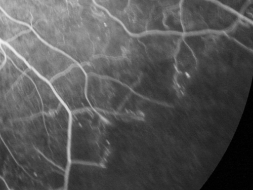 Proliferative Diabetic Retinopathy Both Eyes - Vitreous Hemorrahge Left Eye - Dark Area is Non-Perfusion
67-year-old man has proliferative diabetic retinopathy in both eyes with vitreous hemorrhage in the left eye.  He has had pan retinal laser in the left eye.  The vitreous hemorrhage has been there for greater than two years and his vision is still hazy.  He takes Lumigan in both eyes for his glaucoma.  

VISUAL ACUITY:  OD 20/40,  OS 20/40
