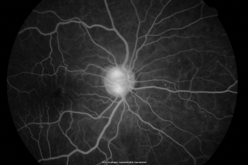 Proliferative Diabetic Retinopathy Both Eyes - Vitreous Hemorrahge Left Eye
67-year-old man has proliferative diabetic retinopathy in both eyes with vitreous hemorrhage in the left eye.  He has had pan retinal laser in the left eye.  The vitreous hemorrhage has been there for greater than two years and his vision is still hazy.  He takes Lumigan in both eyes for his glaucoma.  

VISUAL ACUITY:  OD 20/40,  OS 20/40
