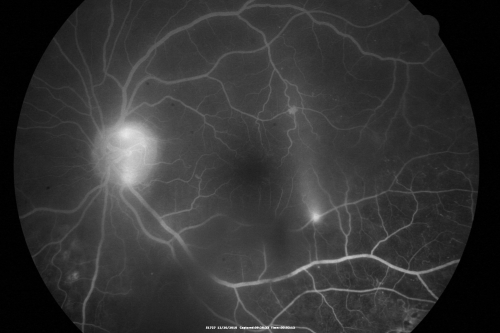 Proliferative Diabetic Retinopathy Both Eyes - Vitreous Hemorrahge Left Eye - Vessel Leaking Fluorescein
67-year-old man has proliferative diabetic retinopathy in both eyes with vitreous hemorrhage in the left eye.  He has had pan retinal laser in the left eye.  The vitreous hemorrhage has been there for greater than two years and his vision is still hazy.  He takes Lumigan in both eyes for his glaucoma.  

VISUAL ACUITY:  OD 20/40,  OS 20/40
