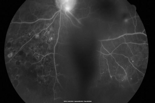 Proliferative Diabetic Retinopathy Both Eyes - Vitreous Hemorrahge Left Eye - Dark Area is Vitreous Hemorrhage
67-year-old man has proliferative diabetic retinopathy in both eyes with vitreous hemorrhage in the left eye.  He has had pan retinal laser in the left eye.  The vitreous hemorrhage has been there for greater than two years and his vision is still hazy.  He takes Lumigan in both eyes for his glaucoma.  

VISUAL ACUITY:  OD 20/40,  OS 20/40
