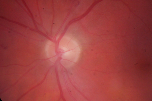 Neovascularization elsewhere (NVE) Left Eye with Vitreous Hemorrhage

