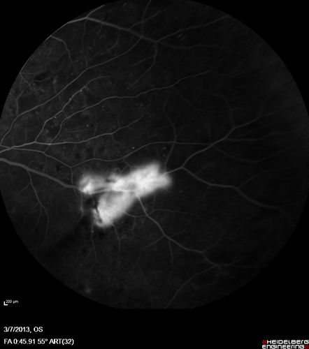 Proliferative Diabetic Retinopathy and Vitreous Hemorrhage - FA shows leakage of dye from NVE
